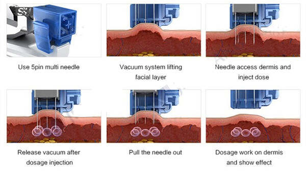 Working principle of mesotherapy